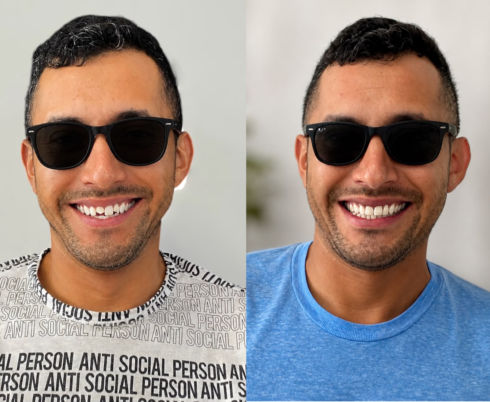 Resultado antes y después de tratamiento dental en Dental Wox, Guadalajara
